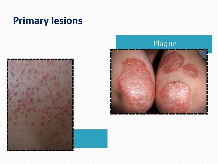 Primary lesions Plaque Papule 