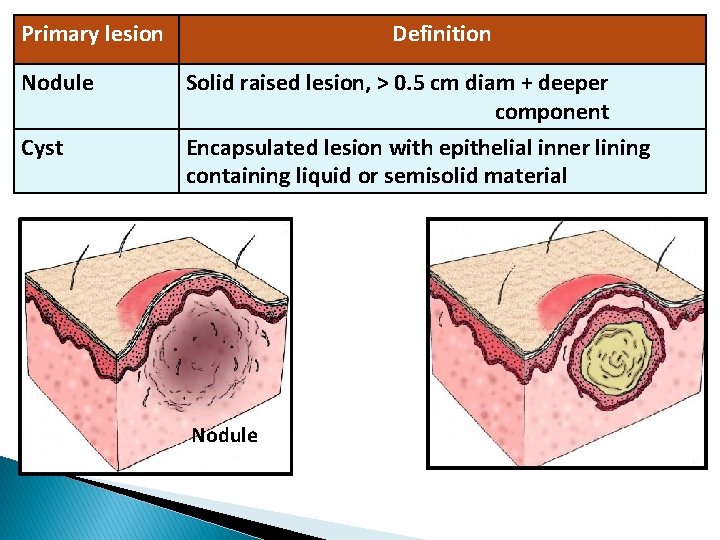 Primary lesion Nodule Cyst Definition Solid raised lesion, > 0. 5 cm diam +