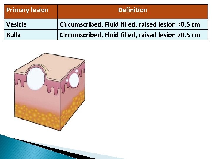 Primary lesion Vesicle Bulla Definition Circumscribed, Fluid filled, raised lesion <0. 5 cm Circumscribed,