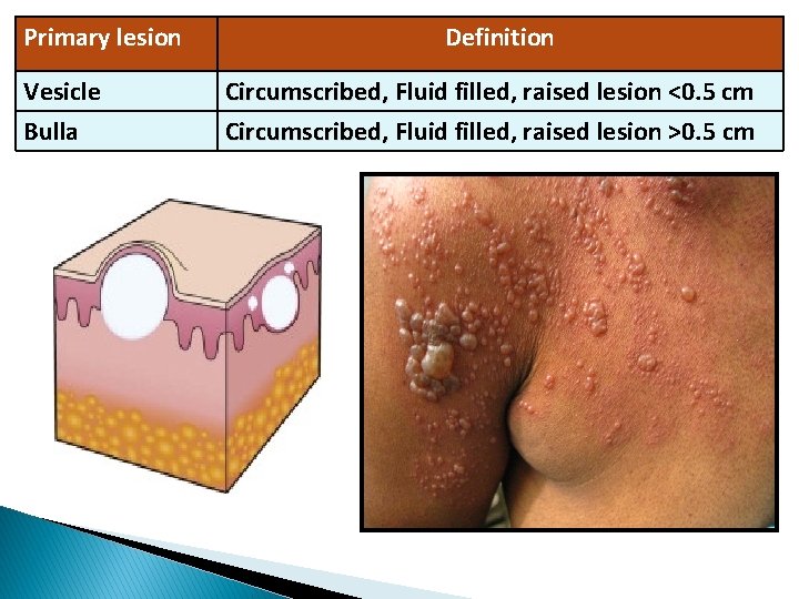 Primary lesion Vesicle Bulla Definition Circumscribed, Fluid filled, raised lesion <0. 5 cm Circumscribed,