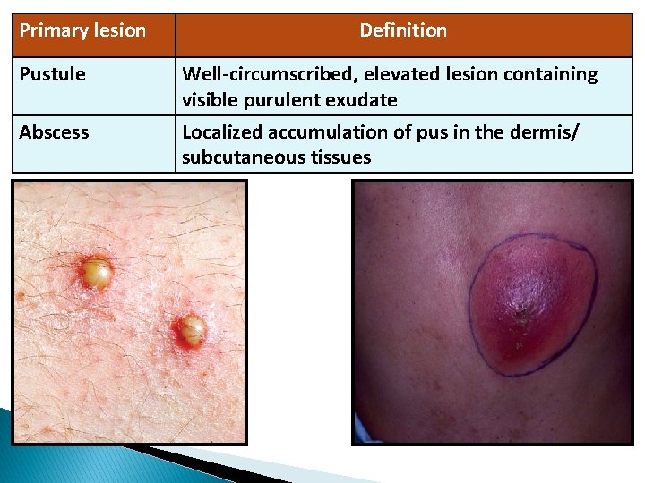 Primary lesion Pustule Abscess Definition Well-circumscribed, elevated lesion containing visible purulent exudate Localized accumulation