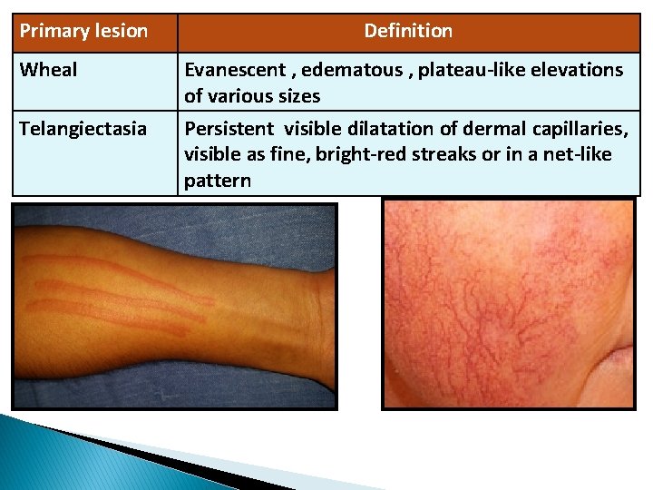 Primary lesion Wheal Telangiectasia Definition Evanescent , edematous , plateau-like elevations of various sizes