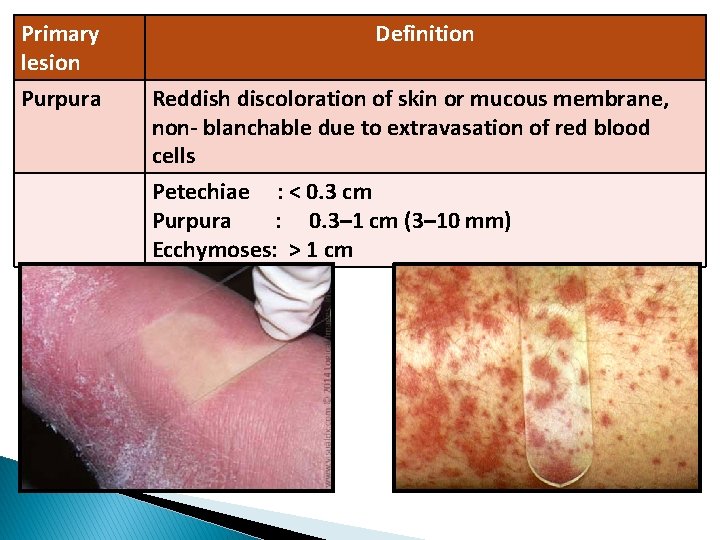 Primary lesion Purpura Definition Reddish discoloration of skin or mucous membrane, non- blanchable due