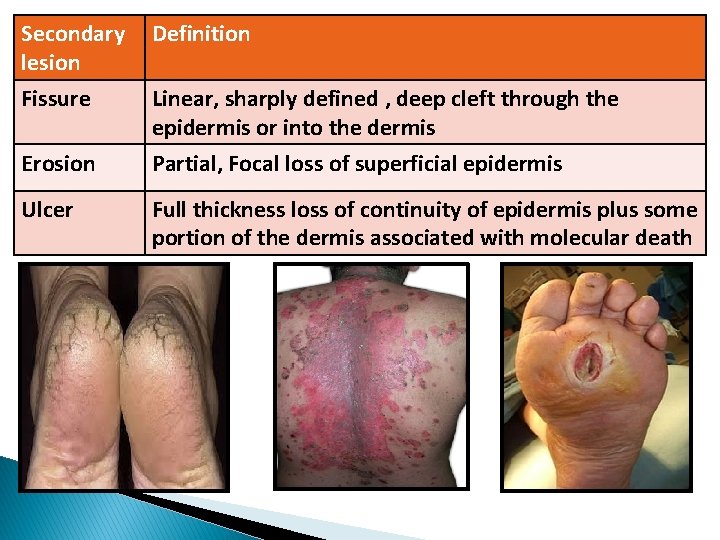 Secondary Definition lesion Fissure Linear, sharply defined , deep cleft through the epidermis or