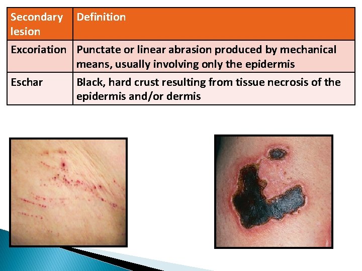 Secondary Definition lesion Excoriation Punctate or linear abrasion produced by mechanical means, usually involving