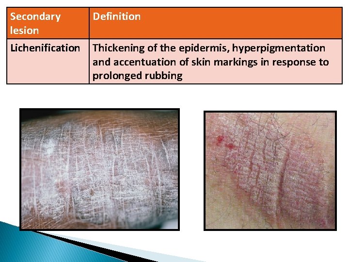 Secondary lesion Definition Lichenification Thickening of the epidermis, hyperpigmentation and accentuation of skin markings