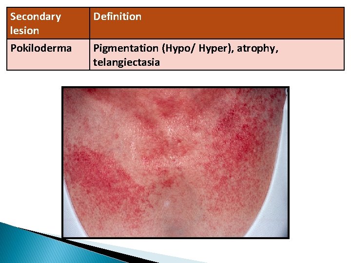 Secondary lesion Definition Pokiloderma Pigmentation (Hypo/ Hyper), atrophy, telangiectasia 