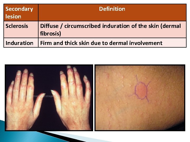 Secondary lesion Definition Sclerosis Diffuse / circumscribed induration of the skin (dermal fibrosis) Induration