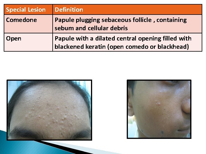 Special Lesion Definition Comedone Papule plugging sebaceous follicle , containing sebum and cellular debris