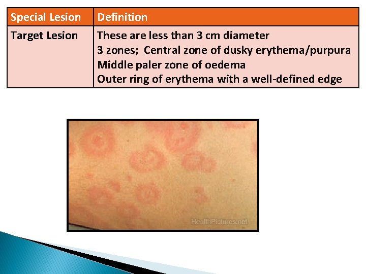 Special Lesion Definition Target Lesion These are less than 3 cm diameter 3 zones;