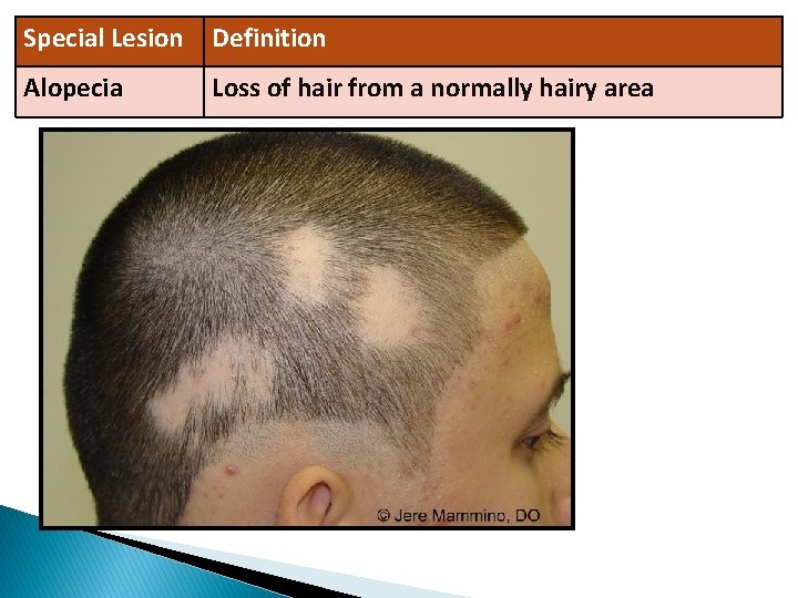 Special Lesion Definition Alopecia Loss of hair from a normally hairy area 
