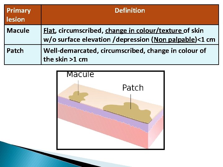 Primary lesion Macule Patch Definition Flat, circumscribed, change in colour/texture of skin w/o surface