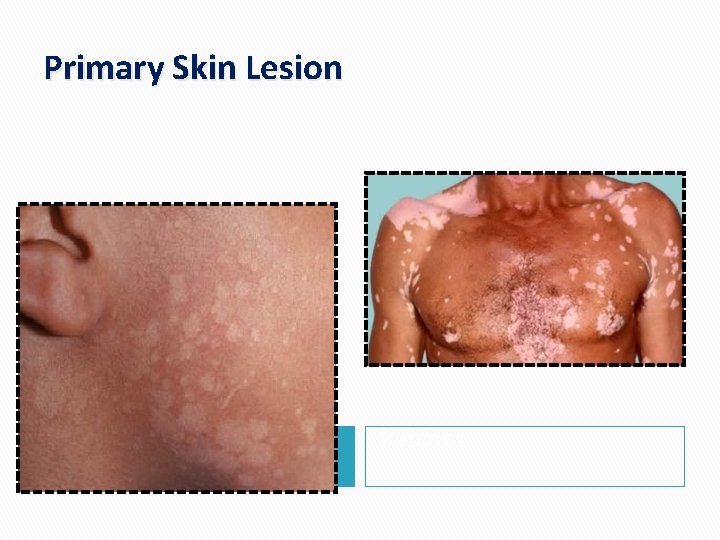 Primary Skin Lesion Macules Patches 