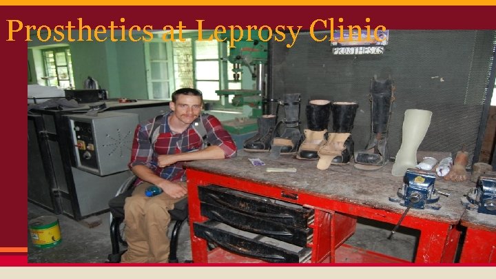 Prosthetics at Leprosy Clinic 