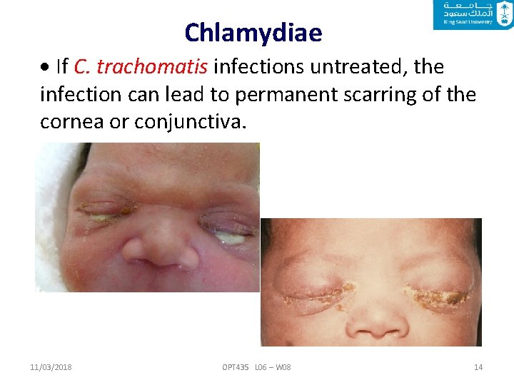 Chlamydiae If C. trachomatis infections untreated, the infection can lead to permanent scarring of