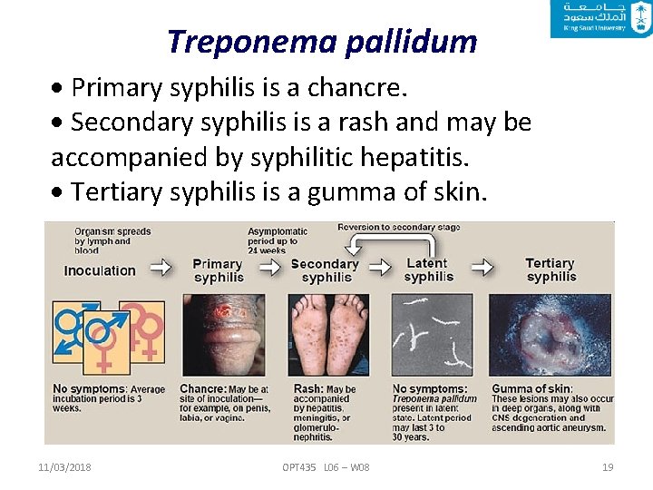 Treponema pallidum Primary syphilis is a chancre. Secondary syphilis is a rash and may