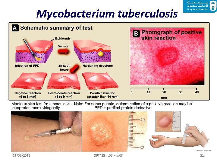 Mycobacterium tuberculosis 11/03/2018 OPT 435 L 06 – W 08 31 