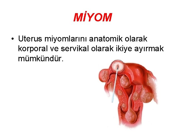 MİYOM • Uterus miyomlarını anatomik olarak korporal ve servikal olarak ikiye ayırmak mümkündür. 