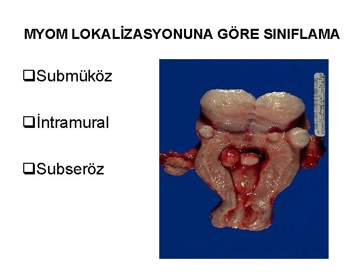 MYOM LOKALİZASYONUNA GÖRE SINIFLAMA q. Submüköz qİntramural q. Subseröz 