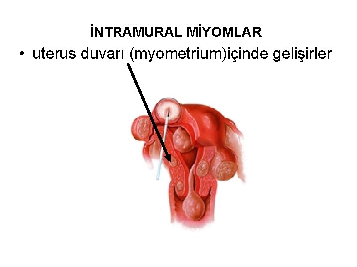 İNTRAMURAL MİYOMLAR • uterus duvarı (myometrium)içinde gelişirler 