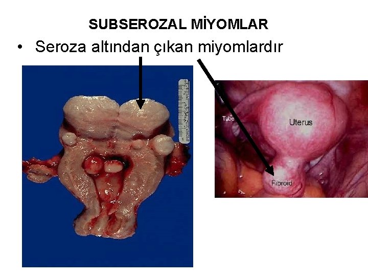 SUBSEROZAL MİYOMLAR • Seroza altından çıkan miyomlardır 