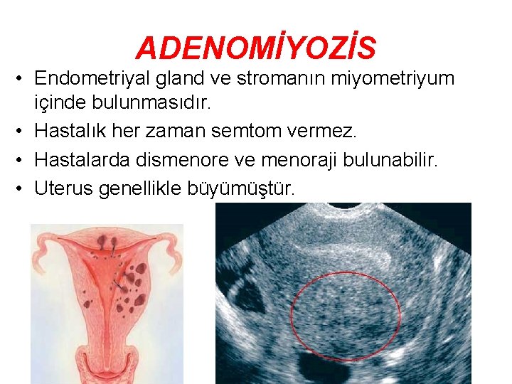 ADENOMİYOZİS • Endometriyal gland ve stromanın miyometriyum içinde bulunmasıdır. • Hastalık her zaman semtom