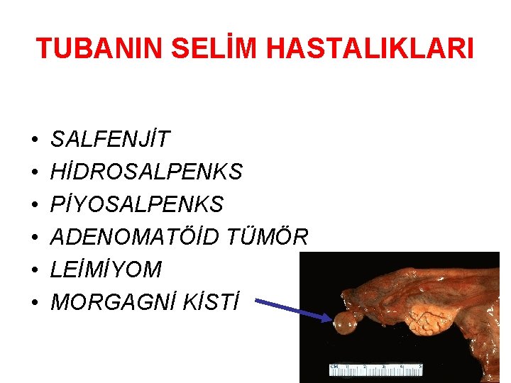 TUBANIN SELİM HASTALIKLARI • • • SALFENJİT HİDROSALPENKS PİYOSALPENKS ADENOMATÖİD TÜMÖR LEİMİYOM MORGAGNİ KİSTİ