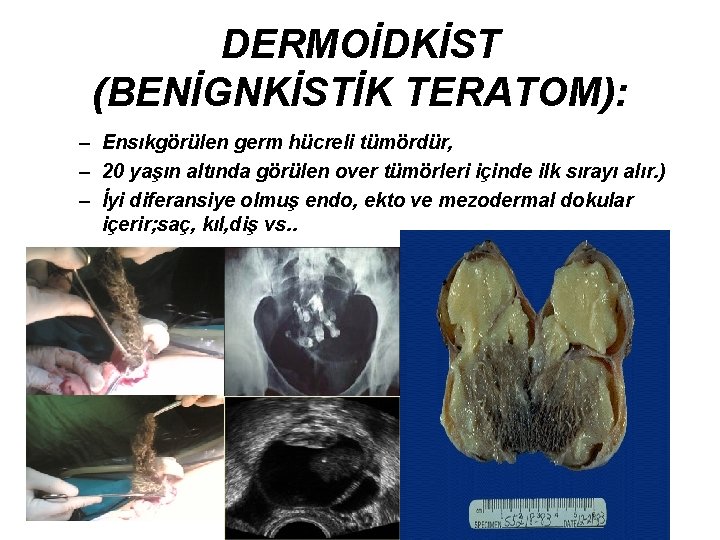 DERMOİDKİST (BENİGNKİSTİK TERATOM): – Ensıkgörülen germ hücreli tümördür, – 20 yaşın altında görülen over