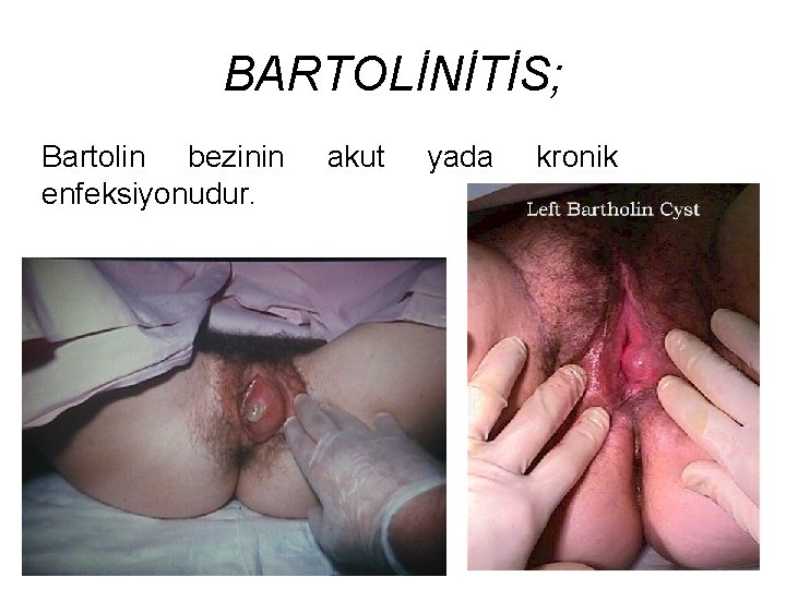 BARTOLİNİTİS; Bartolin bezinin enfeksiyonudur. akut yada kronik 