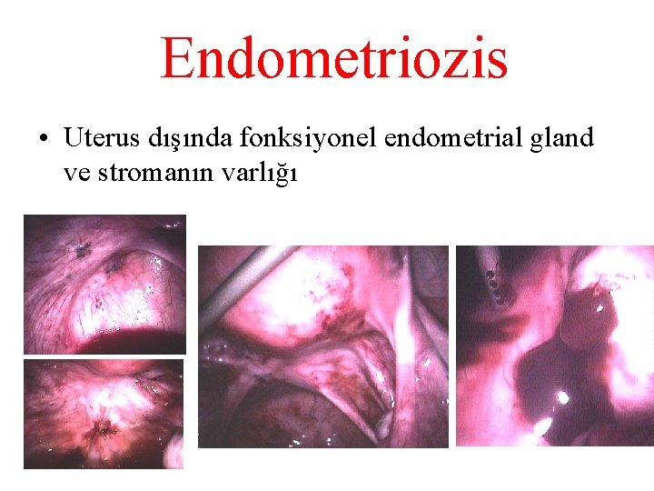 Endometriozis • Uterus dışında fonksiyonel endometrial gland ve stromanın varlığı 