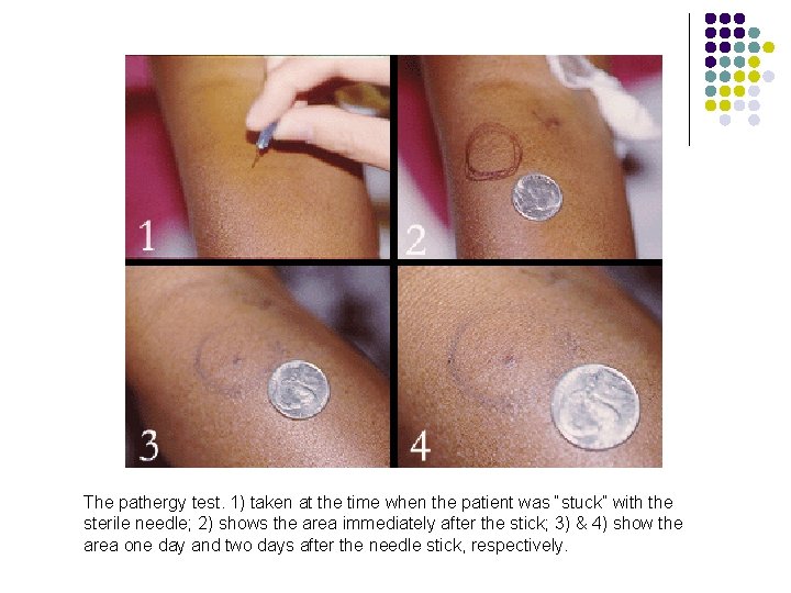 The pathergy test. 1) taken at the time when the patient was “stuck” with