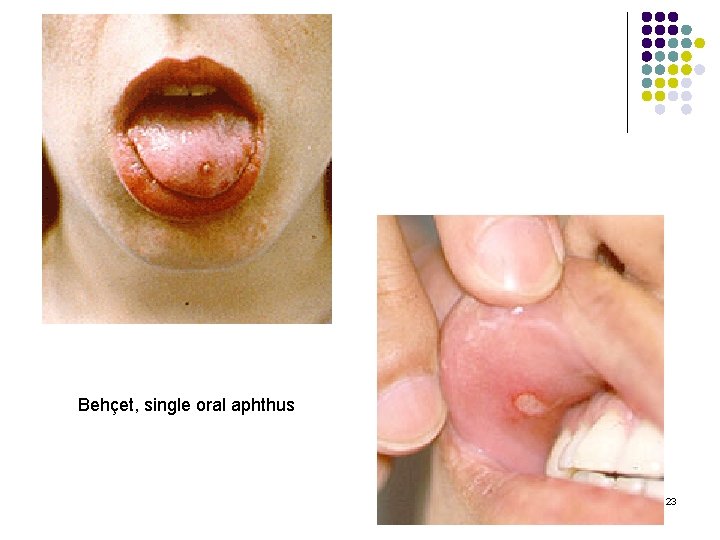 Behçet, single oral aphthus 23 