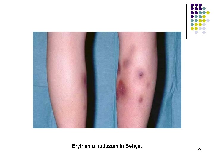 Erythema nodosum in Behçet 36 