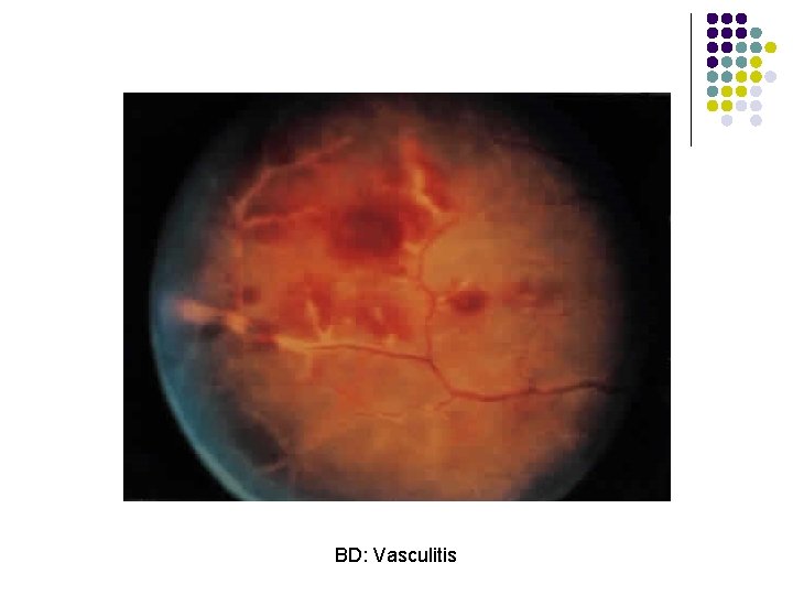 BD: Vasculitis 