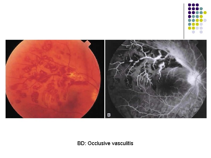 BD: Occlusive vasculitis 