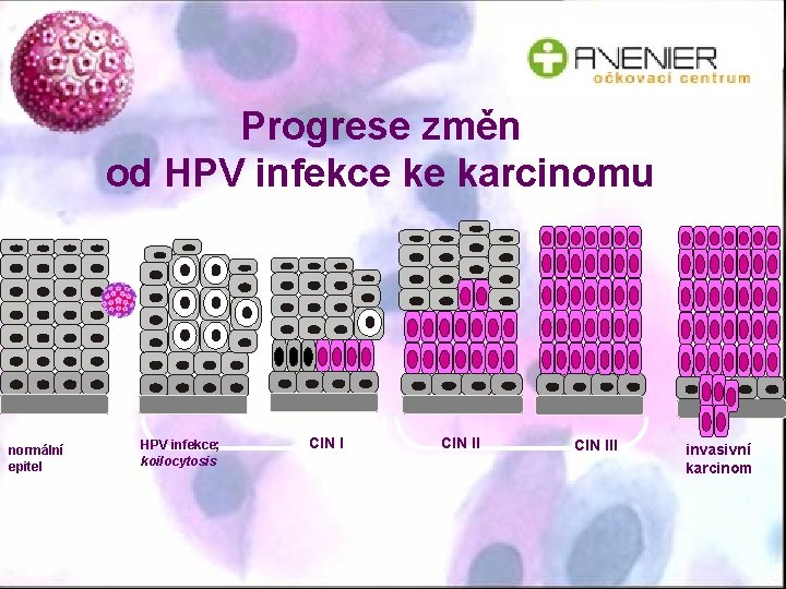 Progrese změn od HPV infekce ke karcinomu normální epitel HPV infekce; koilocytosis CIN III
