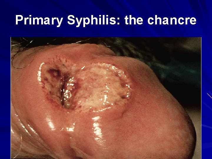 Primary Syphilis: the chancre 