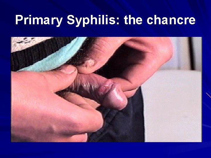 Primary Syphilis: the chancre 