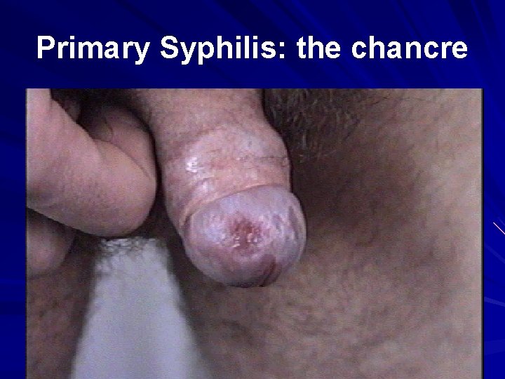 Primary Syphilis: the chancre 