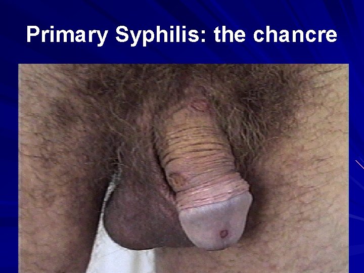 Primary Syphilis: the chancre 