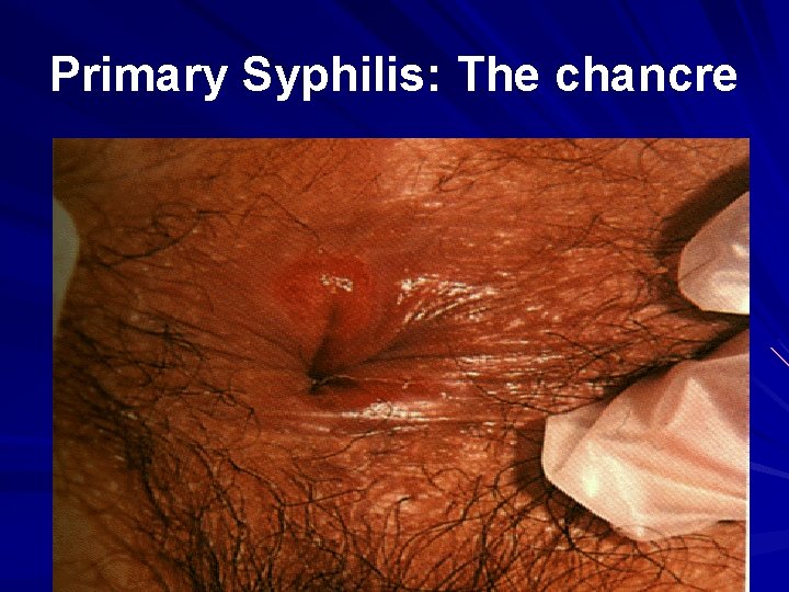 Primary Syphilis: The chancre 