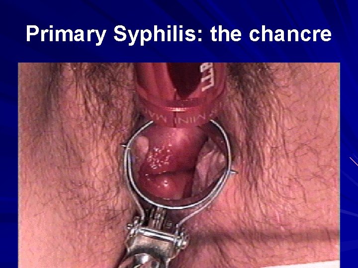 Primary Syphilis: the chancre 