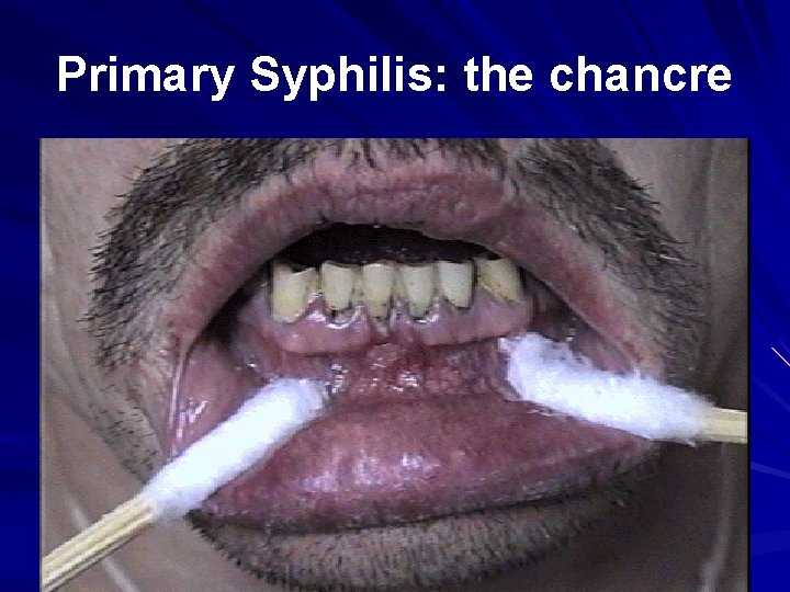 Primary Syphilis: the chancre 