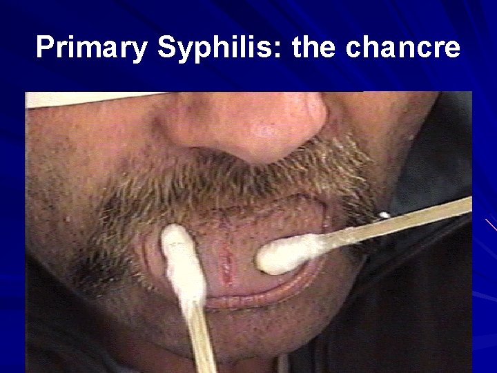 Primary Syphilis: the chancre 