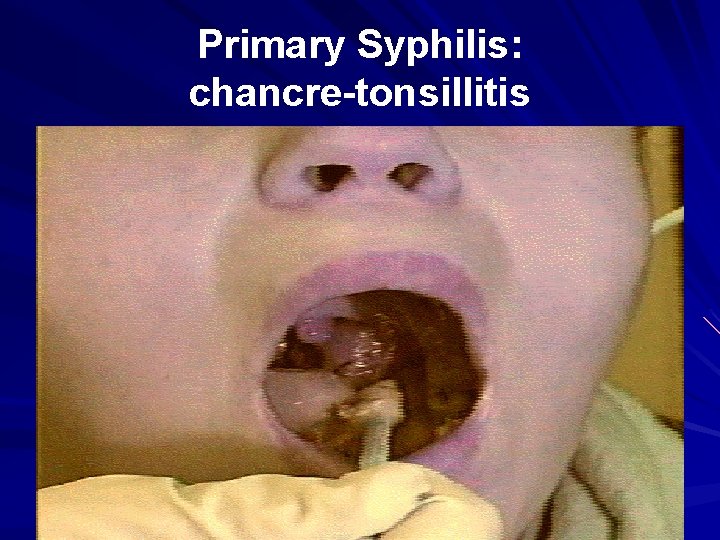 Primary Syphilis: chancre-tonsillitis 