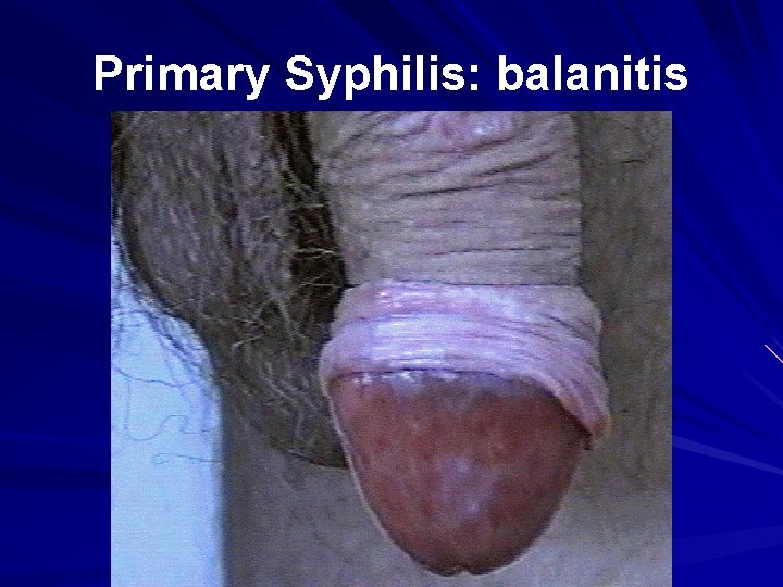 Primary Syphilis: balanitis 