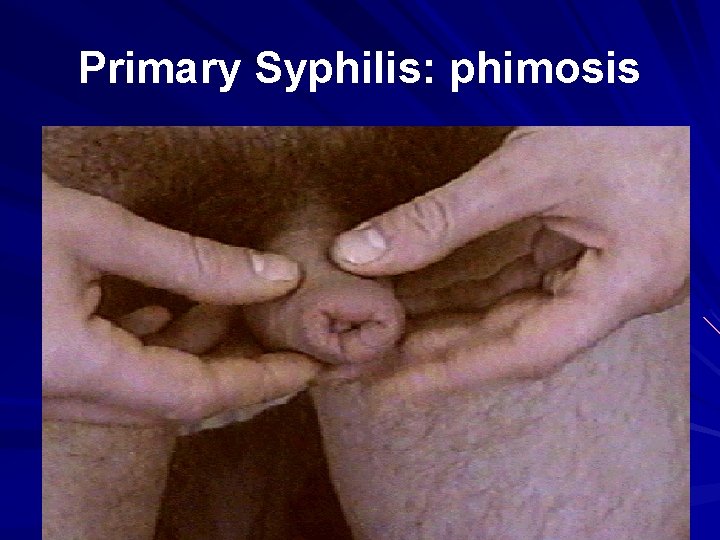 Primary Syphilis: phimosis 