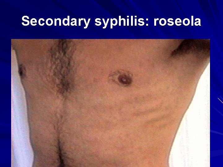 Secondary syphilis: roseola 