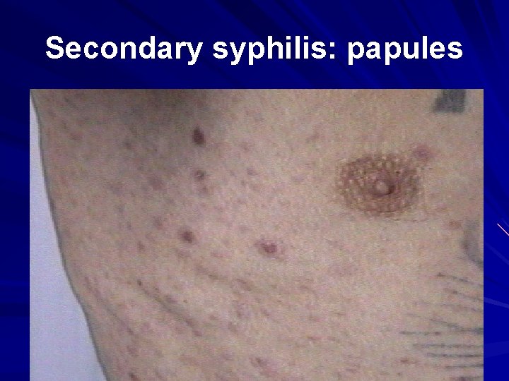 Secondary syphilis: papules 