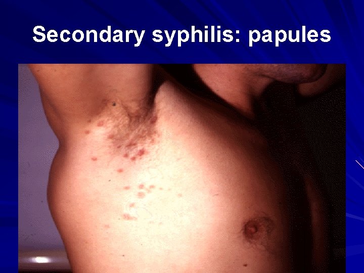 Secondary syphilis: papules 